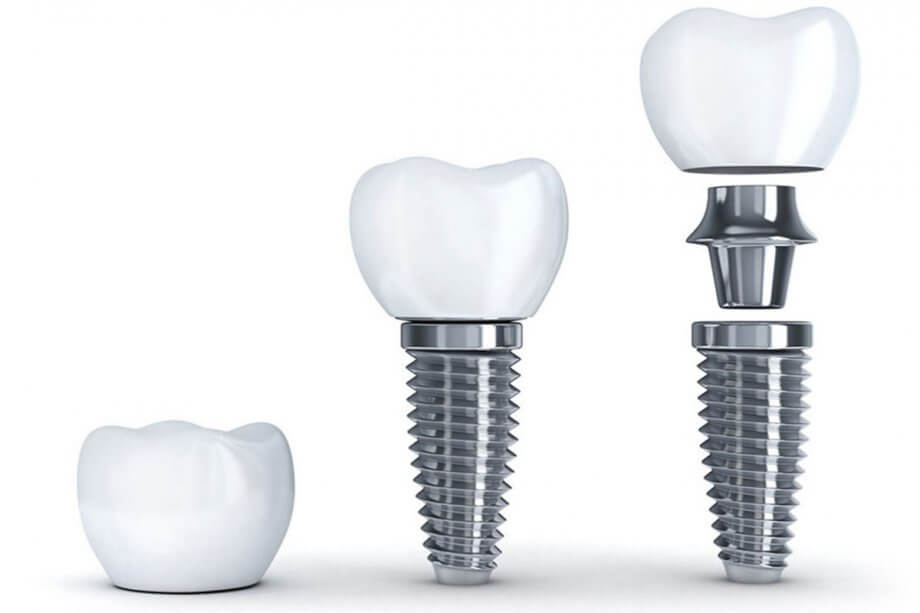 Dental Implants: Myths vs. Facts