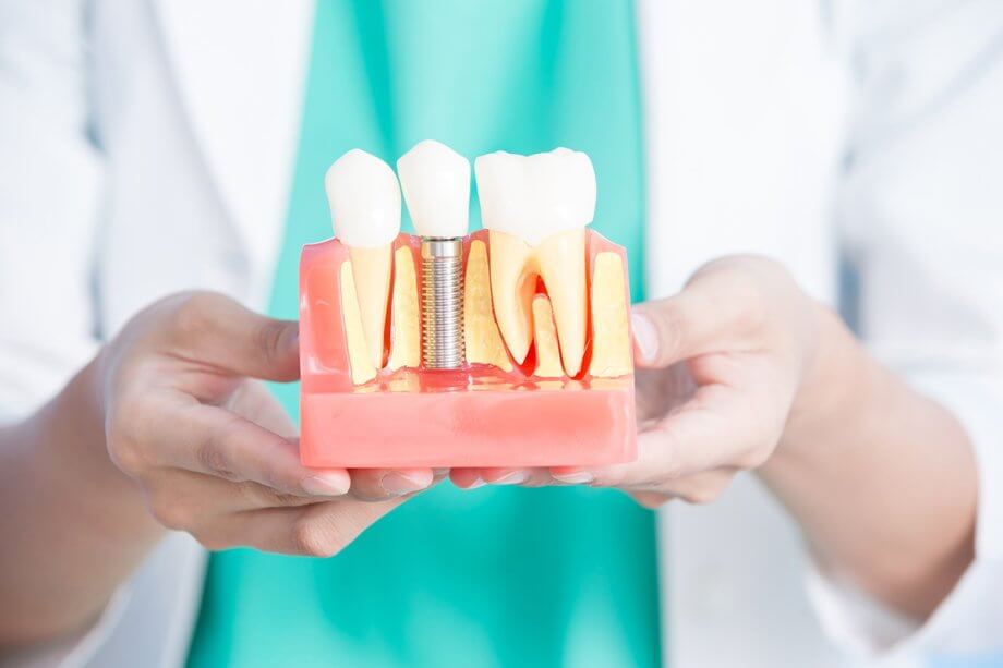 Dental Implants vs Dentures What You Should Know