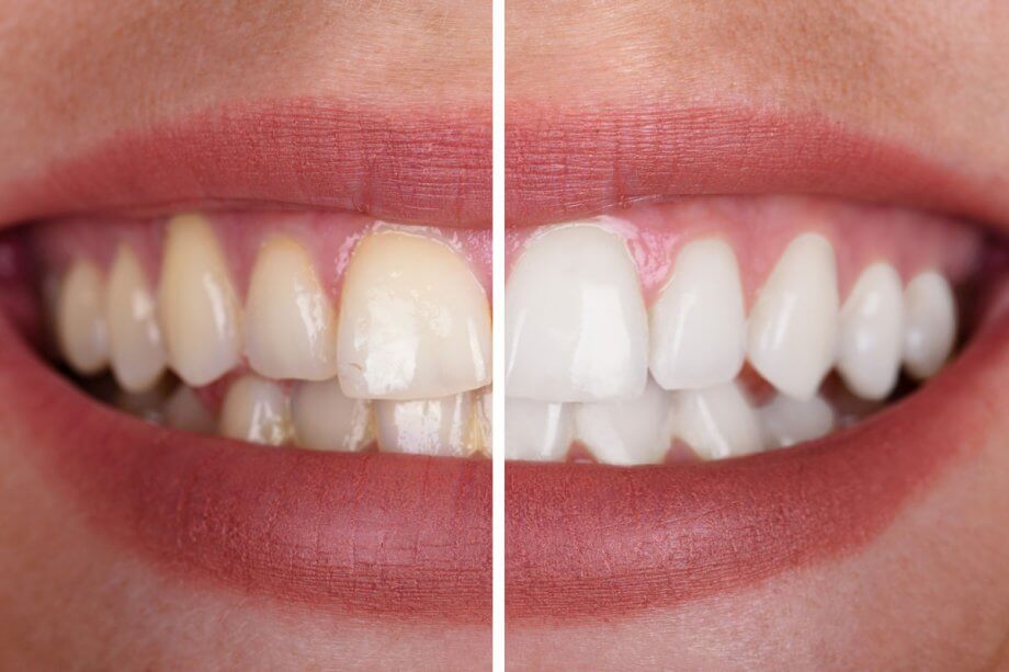 Whitening price teeth Teeth Whitening