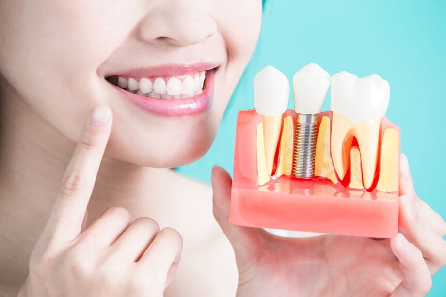 Dental Implant Alternatives: Know Your Options