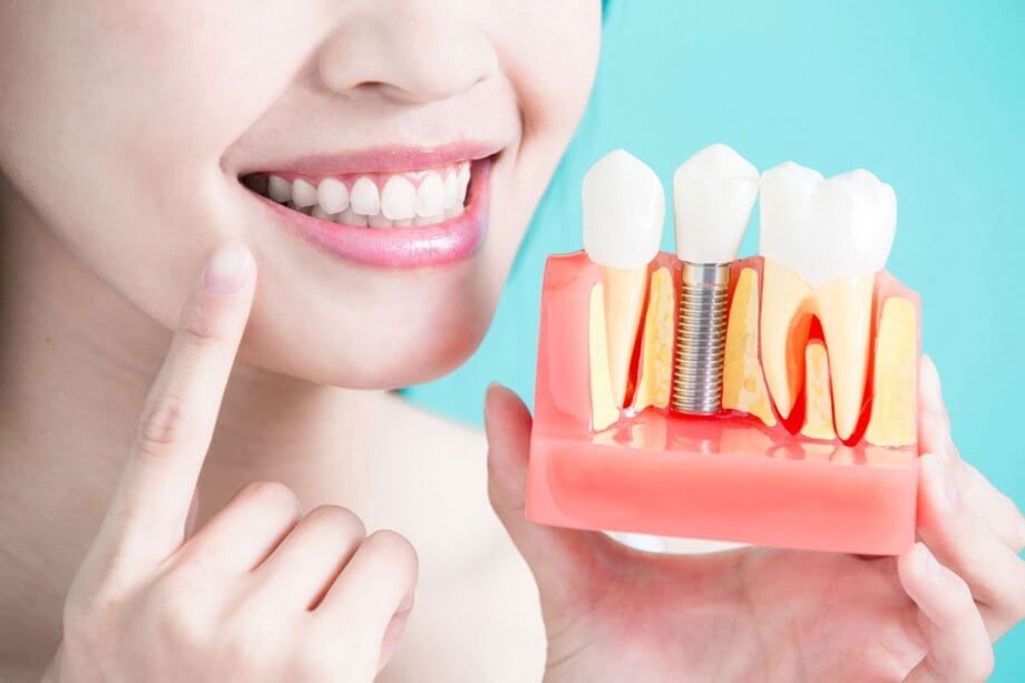 The five benefits of dental implants