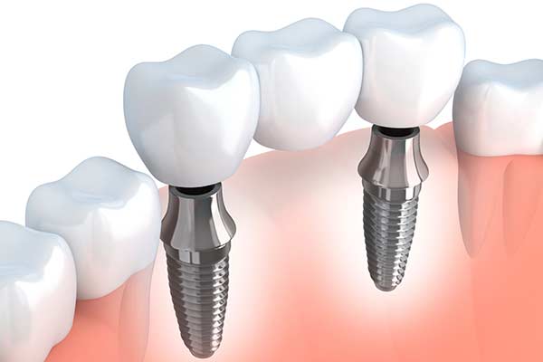 Implant Supported Dentures - Patient Smile