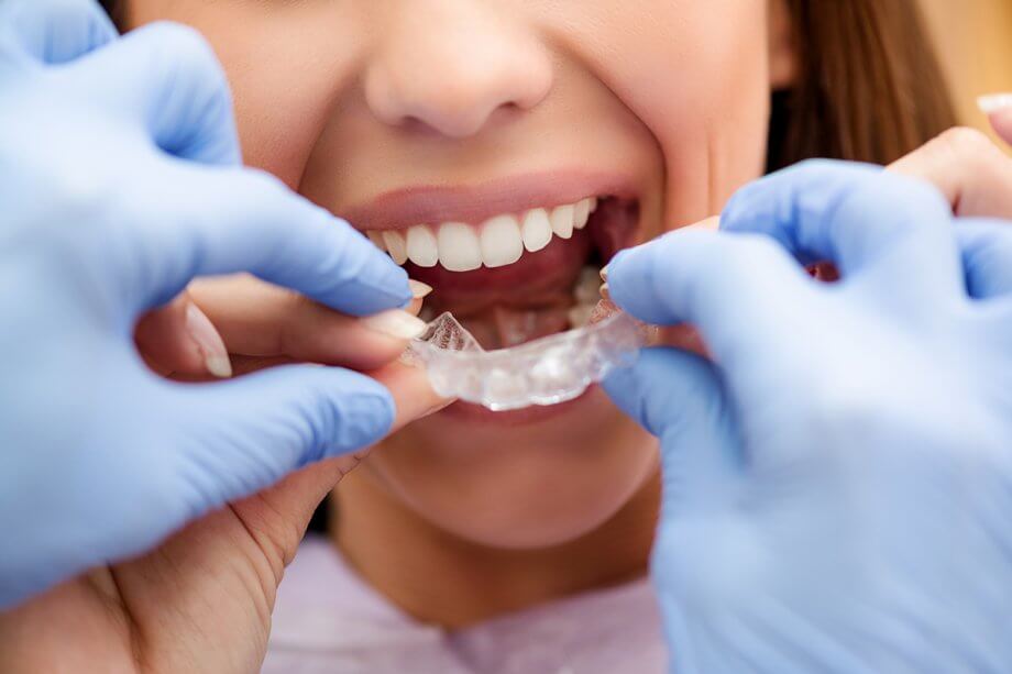 Is Invisalign Worth It for Mild Tooth Misalignment?