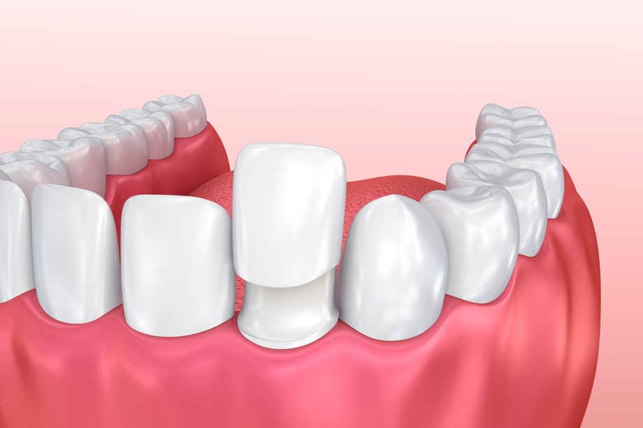 Porcelain vs. Composite Veneers: Which Lasts Longer?