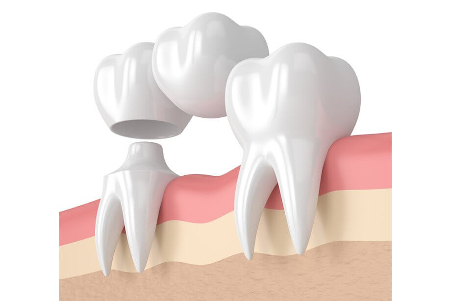 The Pros and Cons of Dental Bridges